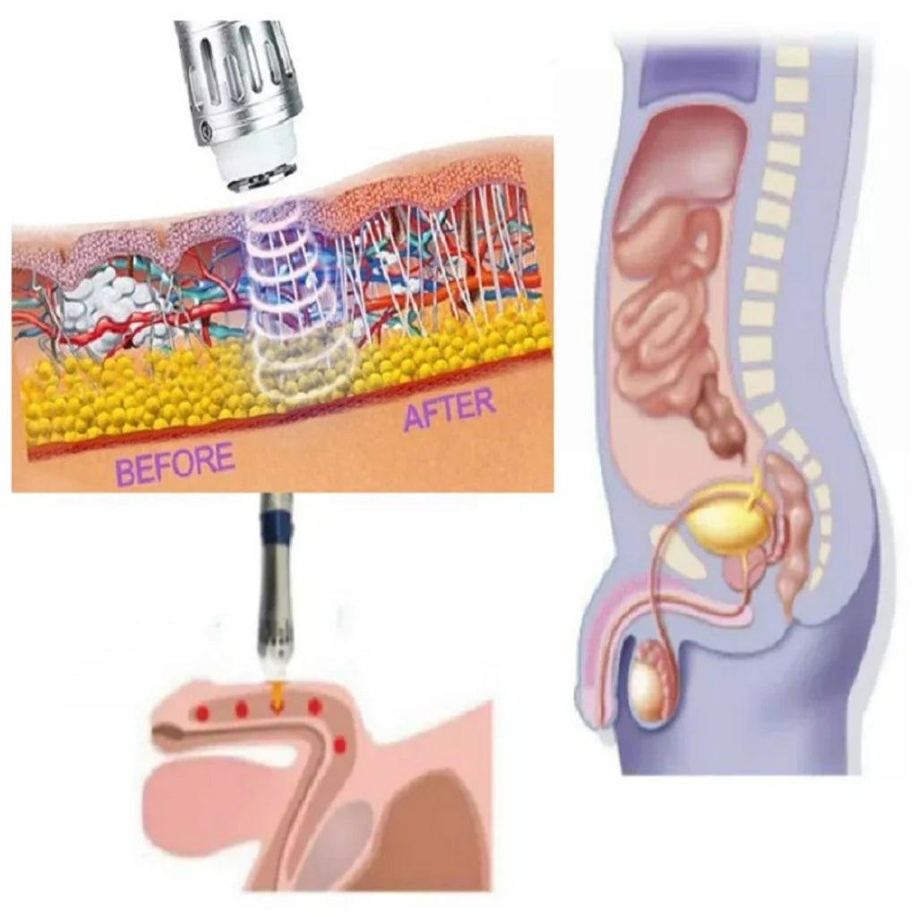 AeroPulse Portable ED Shockwave Therapy Device For Men