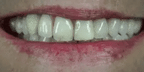 NovaSmile Instant Snap-On Veneers for Upper and Lower Teeth