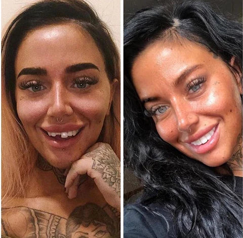 NovaSmile Instant Snap-On Veneers for Upper and Lower Teeth