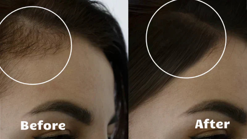 NovaWave Hair Light Therapy for Thicker, Fuller Hair