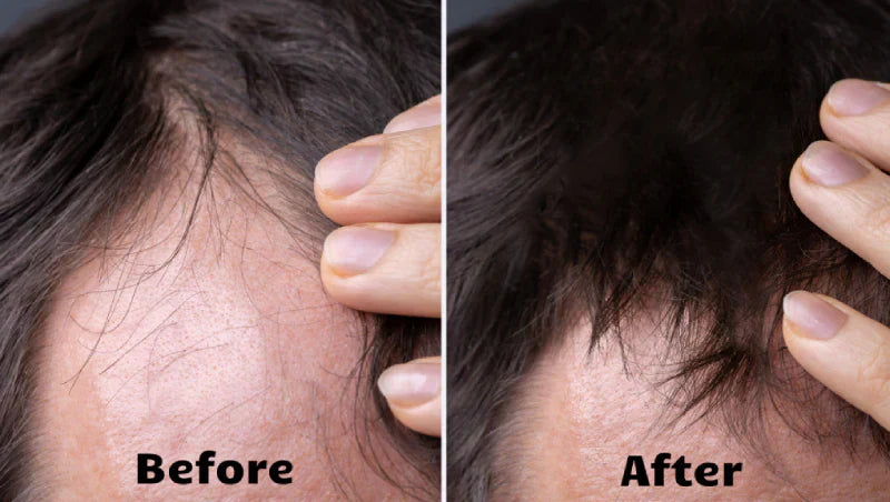 NovaWave Hair Light Therapy for Thicker, Fuller Hair