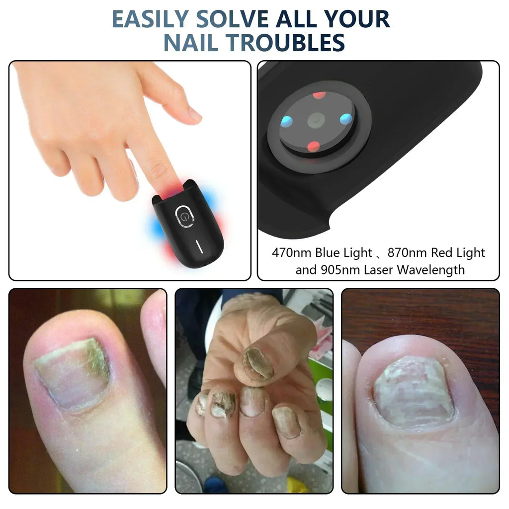 NovaNail Laser Therapy For Toenails With USB Charge