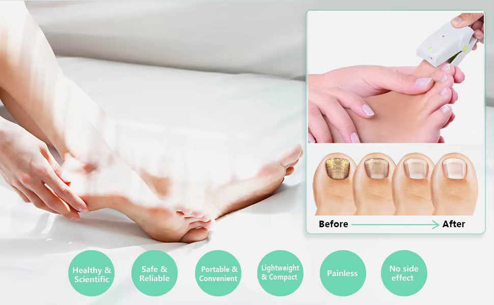 LumaPodi Nail Laser for Fingernail Fungus and Toenail Fungus