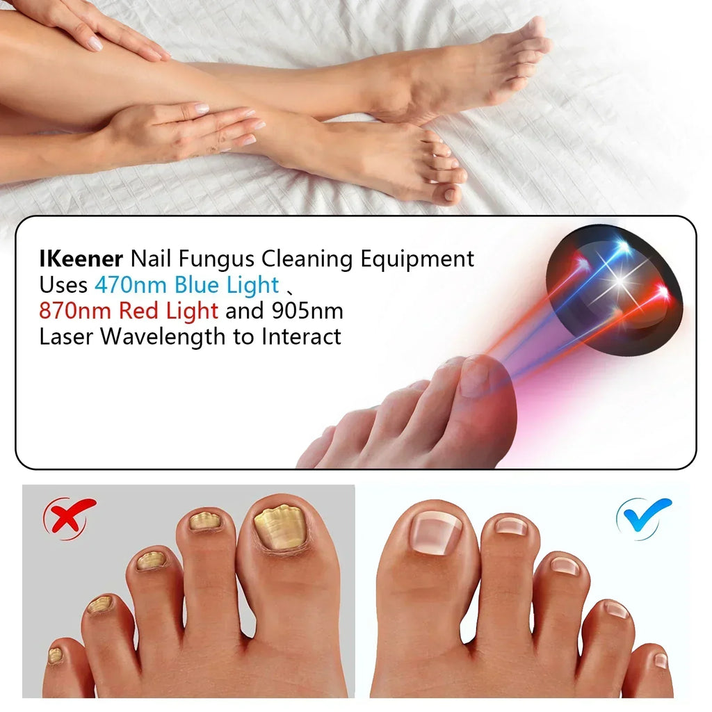 NovaNail Laser Therapy For Toenails With USB Charge