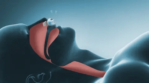 Nebula CPAP Nano Quiet Sleep Apnea And Snoring Aid