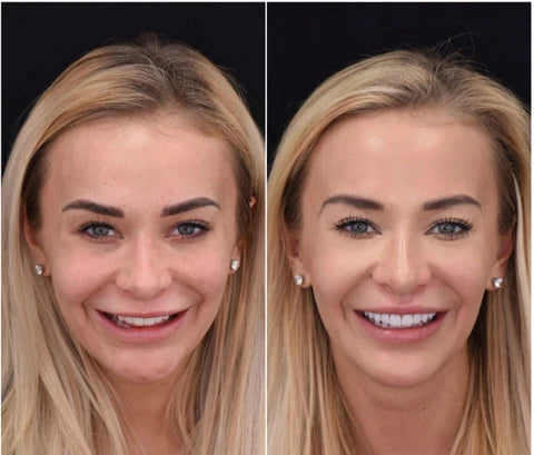 NovaSmile Instant Snap-On Veneers for Upper and Lower Teeth