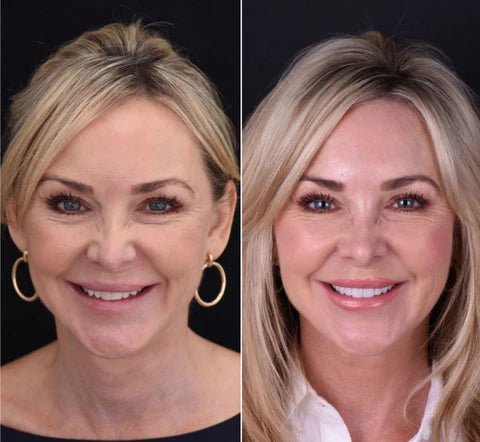 NovaSmile Instant Snap-On Veneers for Upper and Lower Teeth