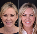 NovaSmile Instant Snap-On Veneers for Upper and Lower Teeth