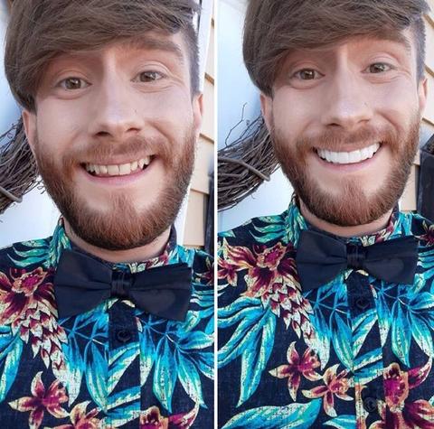 NovaSmile Instant Snap-On Veneers for Upper and Lower Teeth